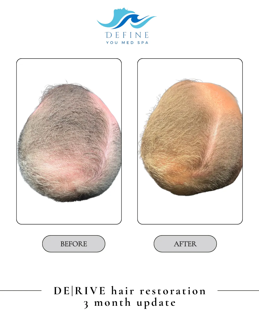 DE|RIVE hair restoration before and 3 months after