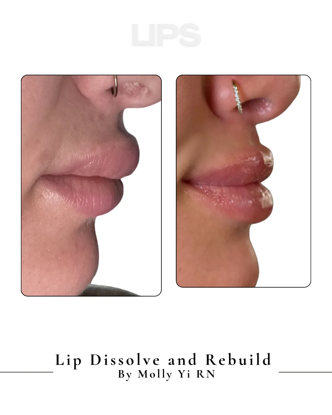 Lip filler dissolve and rebuild before and after
