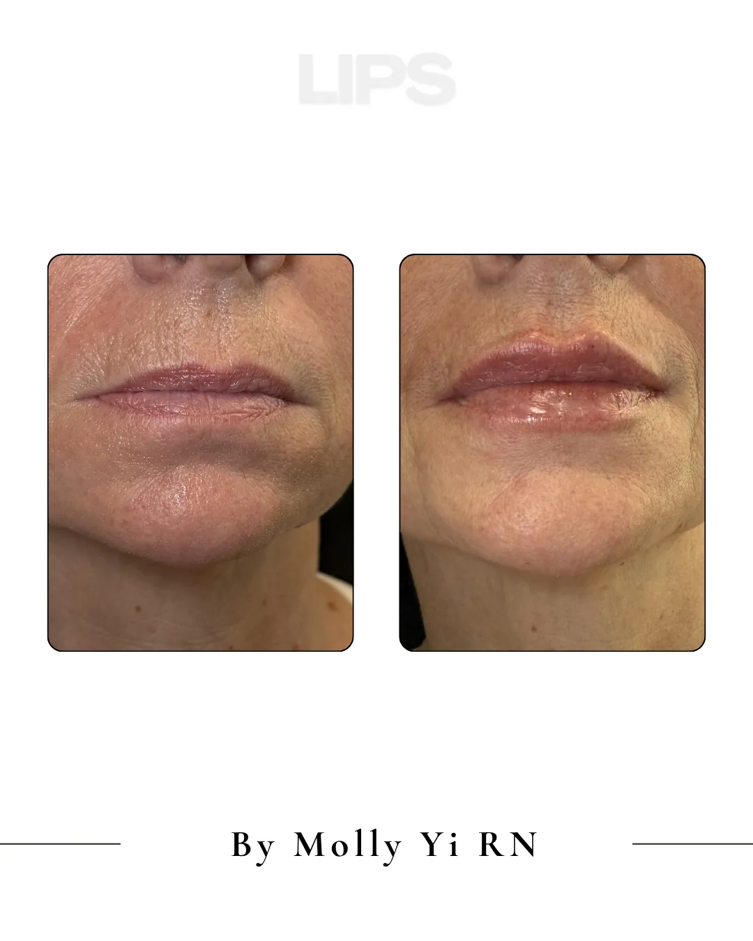 Lip filler before and after, by Molly Yi, RN