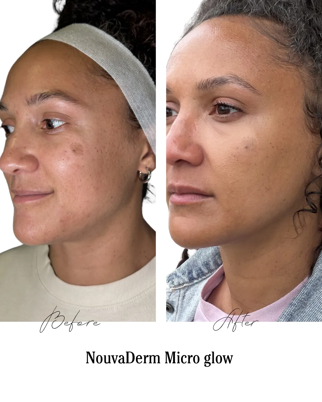 NouvaDerm Micro Glow laser treatment before and after