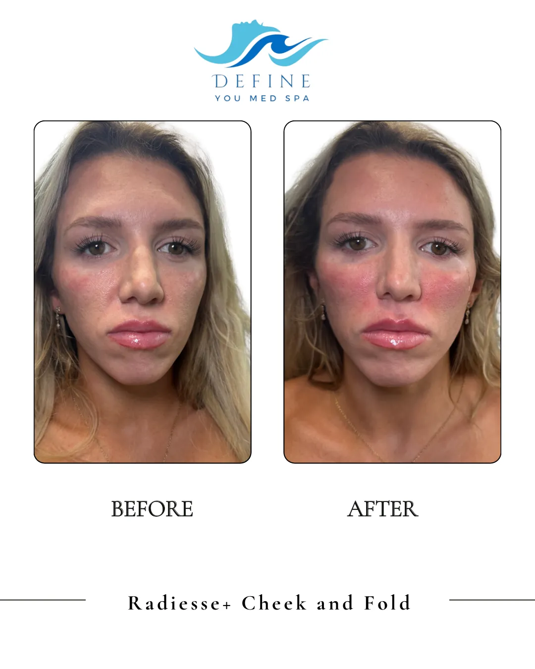 Radiesse cheek and nasolabial fold before and after