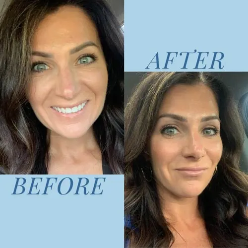 Female face before and after treatment at Define You Med Spa